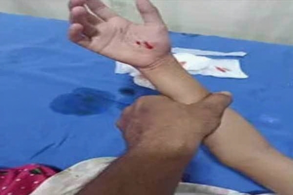 ಸುರತ್ಕಲ್ನಲ್ಲಿ ಬೀದಿನಾಯಿಗಳ ದಾಳಿ : ಬಾಲಕಿ ಗಂಭೀರ ಗಾಯ